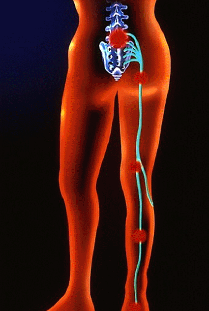 Image: Artwork of standing figure showing areas of pain associated with sciatica (Photo courtesy of BSIP ESTIOT / SPL).